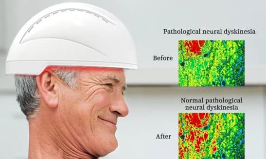 Fotobiomodulação Transcraniana